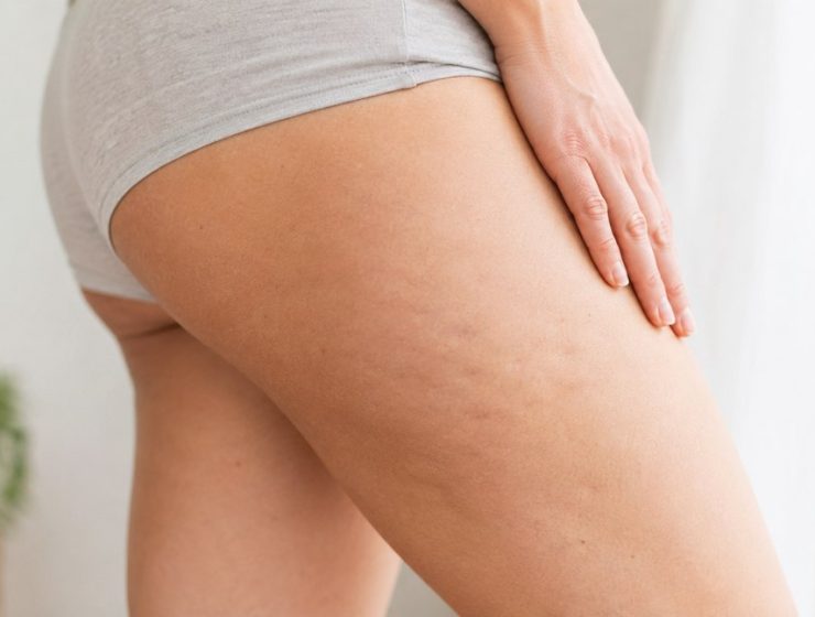 Cellulit a comb bőrén közelről – a felnőtt nők többségét érintő természetes jelenség